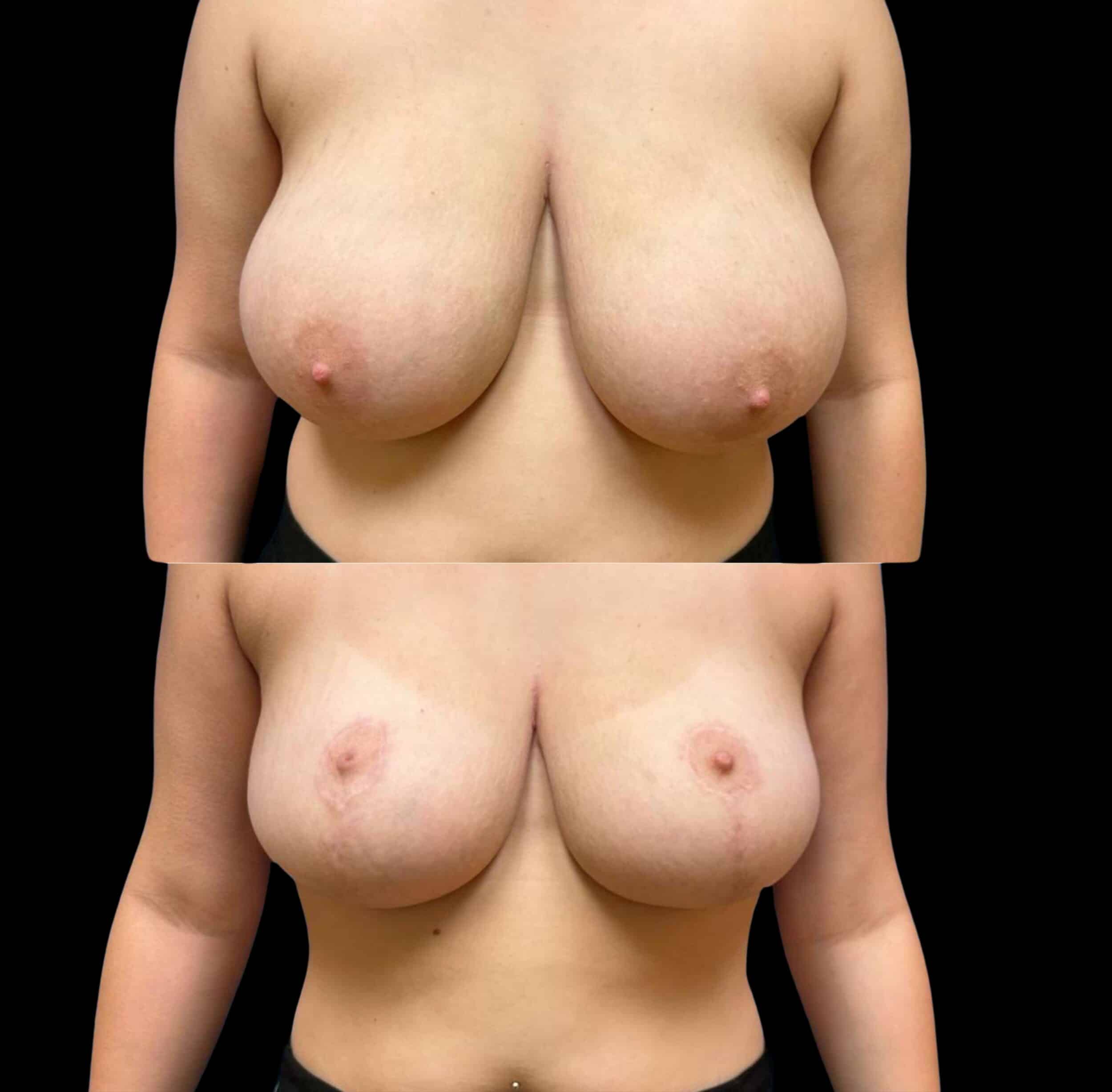 Before and After Image: Bilateral Breast Reduction - front