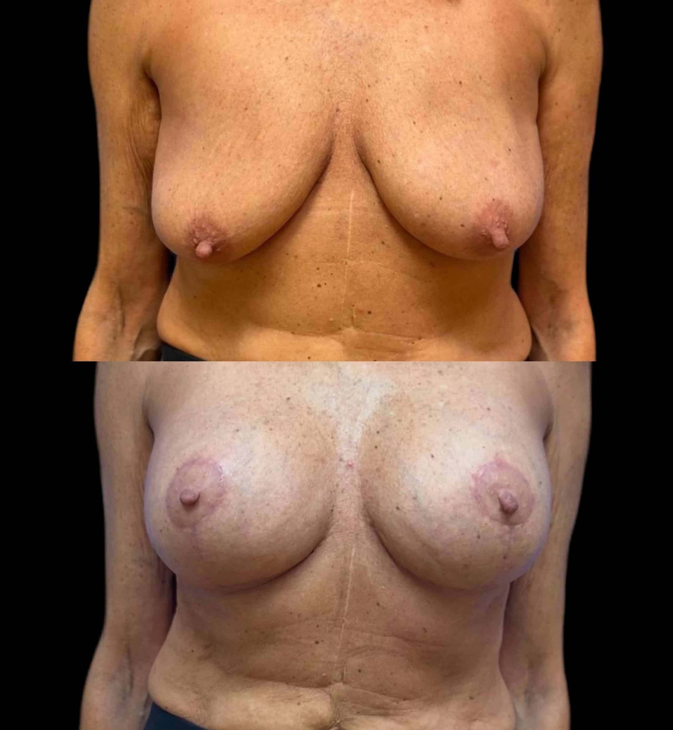 Before and After Image: Mastopexy – Augmentation - front