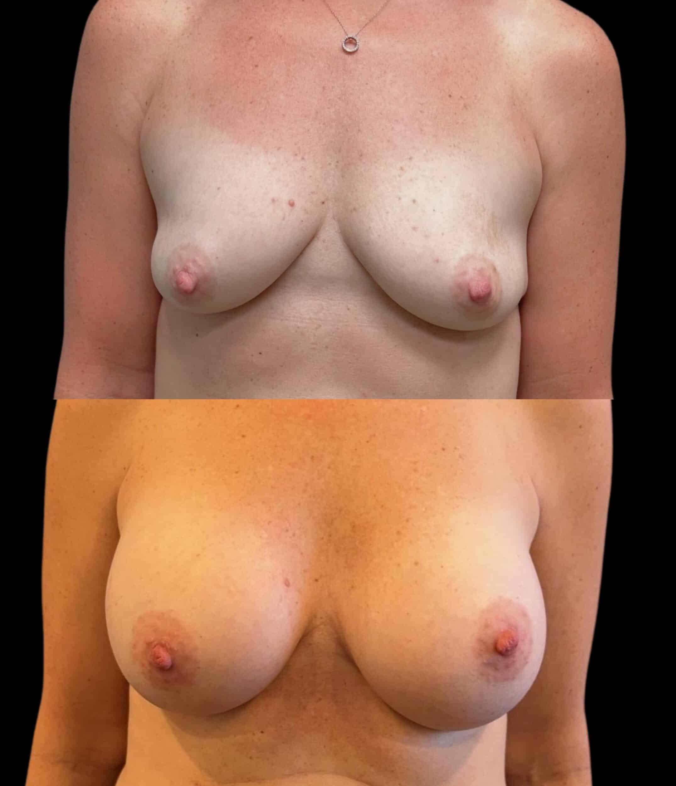 Before and After Image: Bilateral Breast Augmentation - front