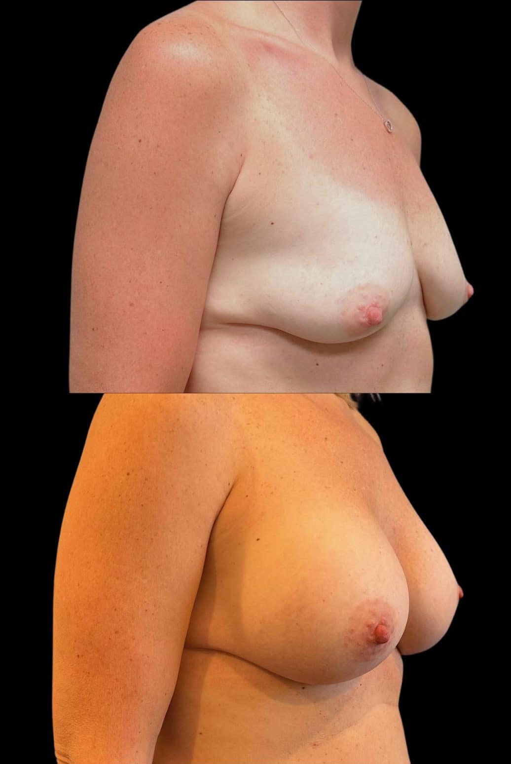 Before and After Image: Bilateral Breast Augmentation - right-front-oblique