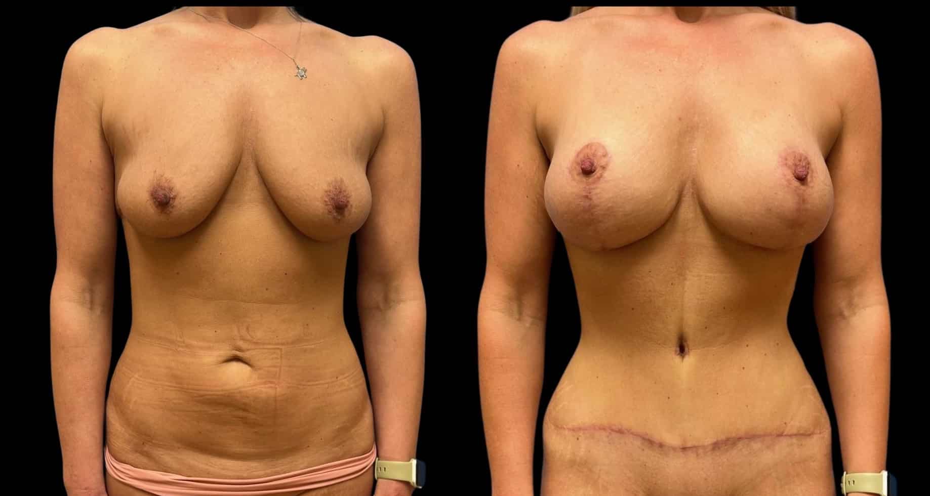 Before and After Image: Mommy Makeover - front