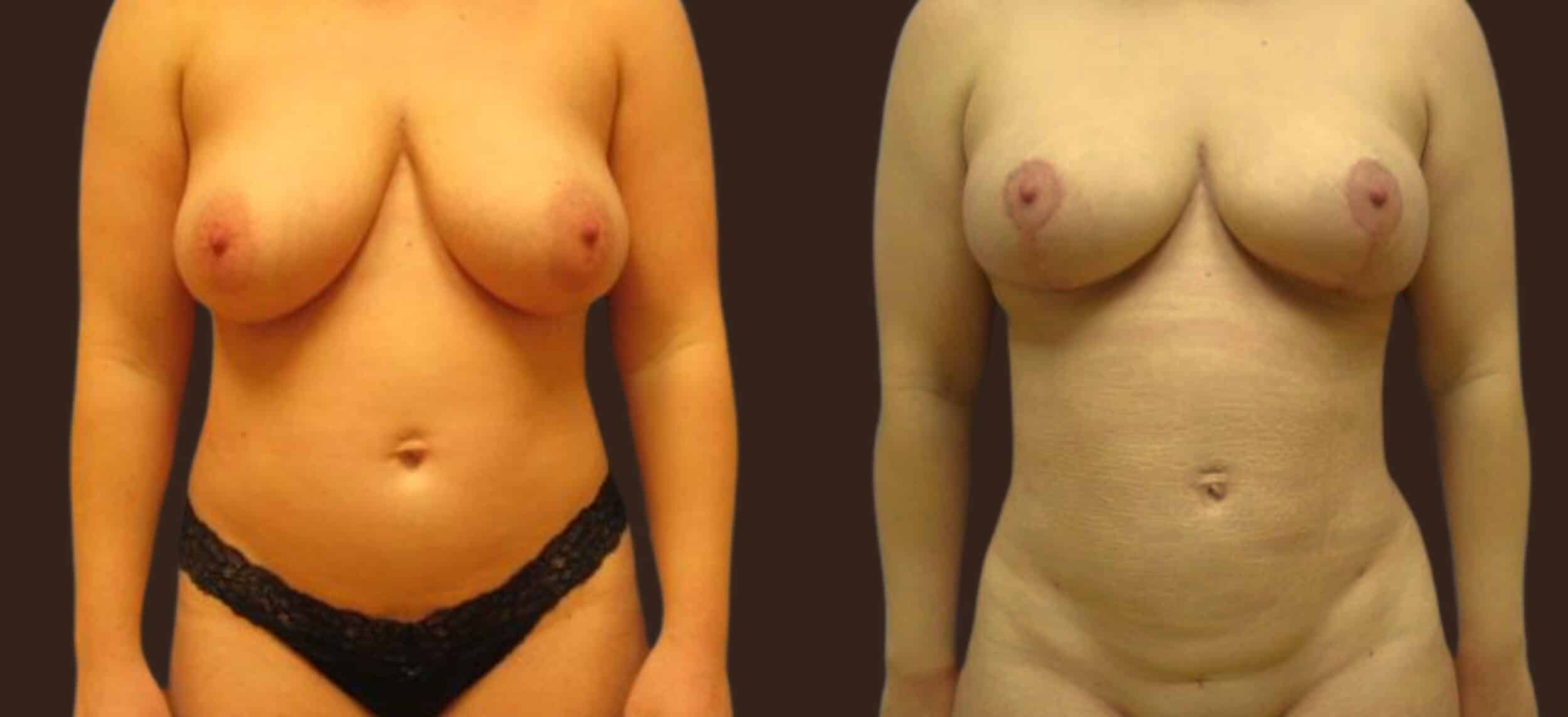 Before and After Image: Mastopexy - front